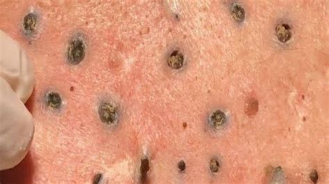 Jan 30, 2021 This is my patient with many blackheads, she is making progress, it takes multiple sessions when you have hundreds upon hundreds of waxy embedded plugs. . Giant blackheads part 5